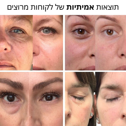 פאצ'ים לטיפול בכהויות, נפיחות וקמטוטי עניים - PuraDerma™