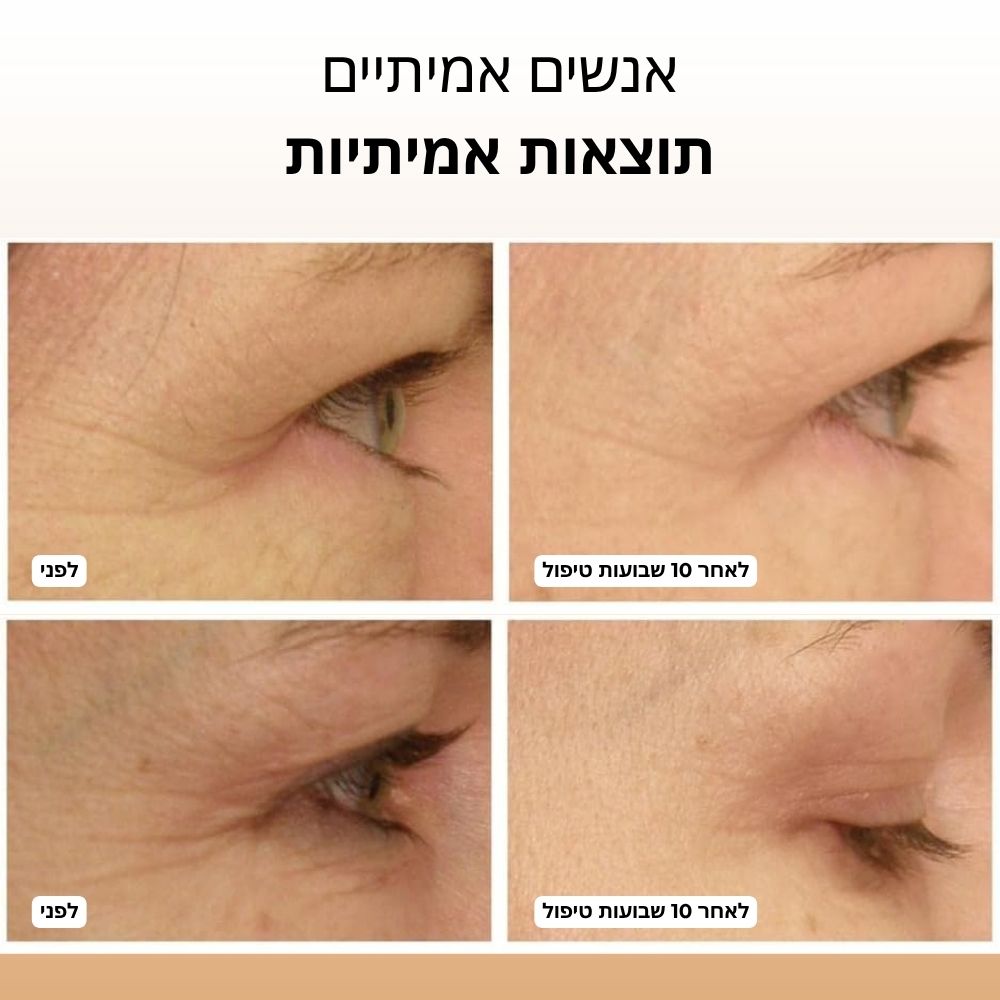 משקפי אור אדום לטיפול בשקעי עיניים, נפיחות וקמטוטים - PuraDerma™