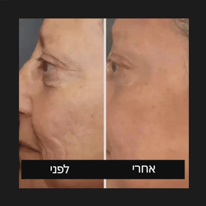ערכת ההתחדשות העור - שלוש אמפולות טיפוליות